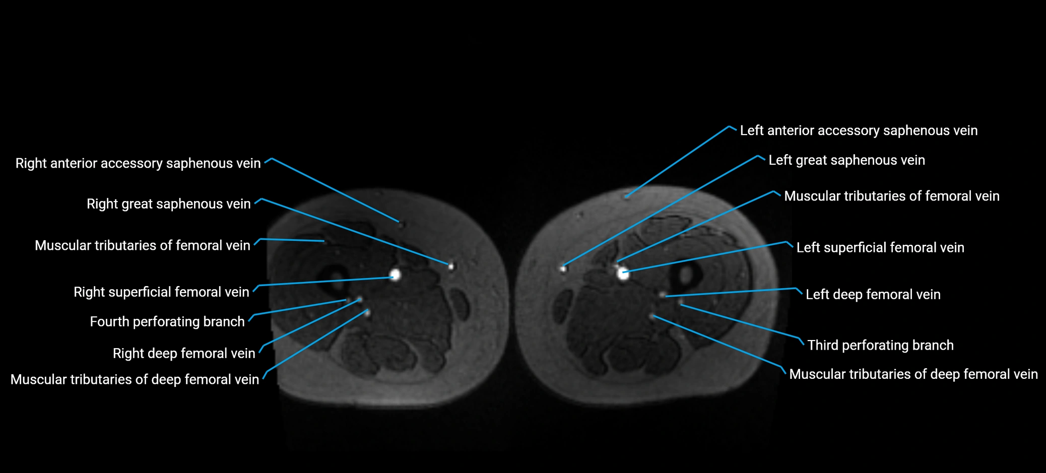 MRV abdomen pelvis & lower limb axial cross sectional anatomy labelled MRI image 263 (1).webp